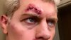 01-cody-eight-stitches-in-cut-right-eye-after-aew-full-gear-11-10-2019.jpg